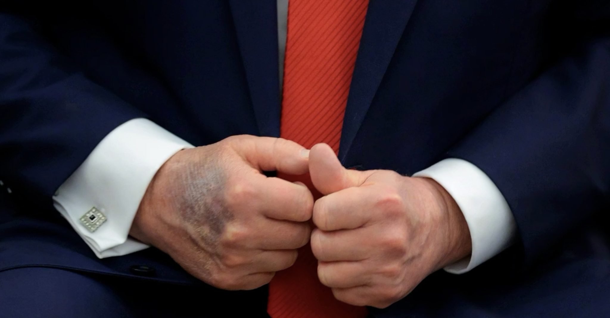 Mancha roxa volta a aparecer na mão de Donald Trump e reabre debate sobre insuficiência venosa 1 Mancha roxa volta a aparecer na mão de Donald Trump e reabre debate sobre insuficiência venosa - Imagem do artigo original