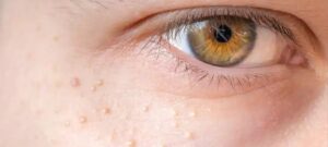 Especialistas alertam sobre manchas brancas na pele e na região íntima: entenda causas, riscos e cuidados